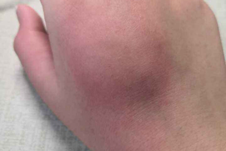 茶毛虫皮炎肿块图