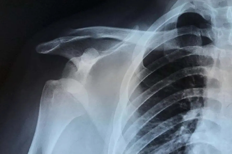 肩关节半脱位X线图