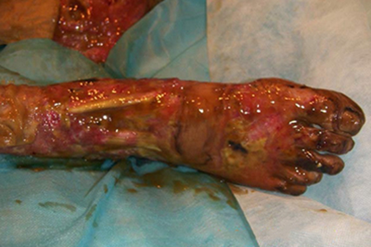 三度烫伤脚部症状图