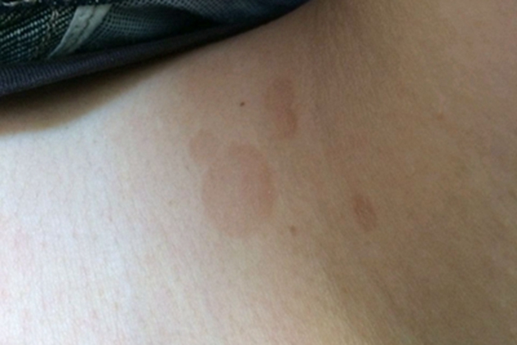 花斑糠疹脖子上有红斑图