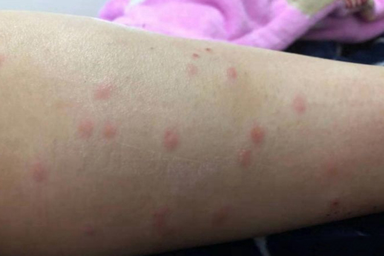 麻疹小腿丘疹图