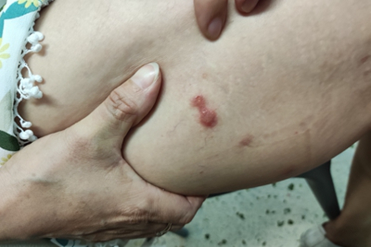 结节性痒疹大腿丘疹图