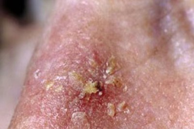 老年性角化病鼻部结痂图