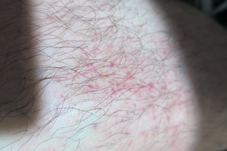 毛囊炎腿症状图