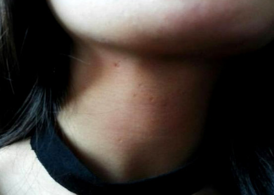 特发性皮下脂肪萎缩颈部小坑图