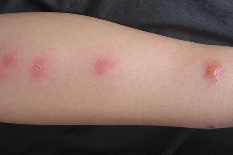 蜱叮咬局部红斑中央瘀点图