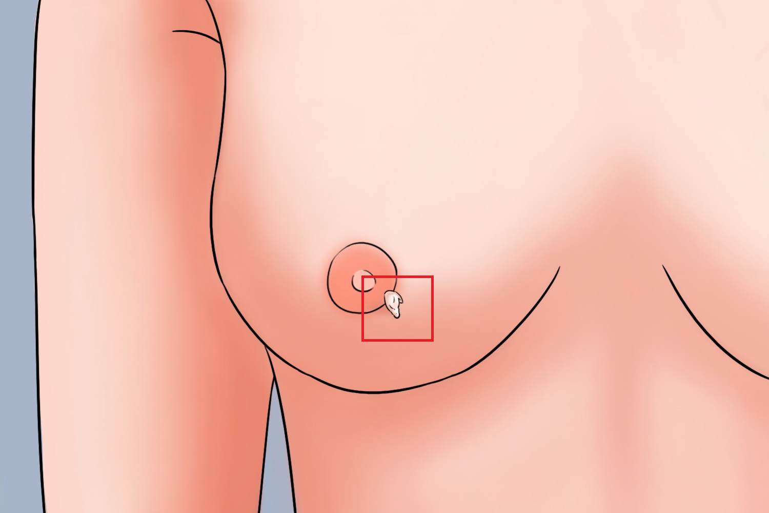 乳头浅褐色软纤维瘤图 乳头浅褐色软纤维瘤图