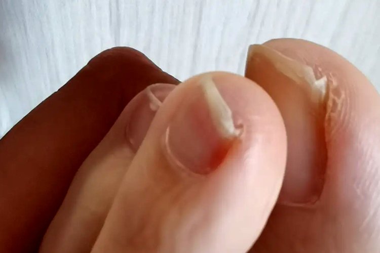 脚趾轻度嵌甲图