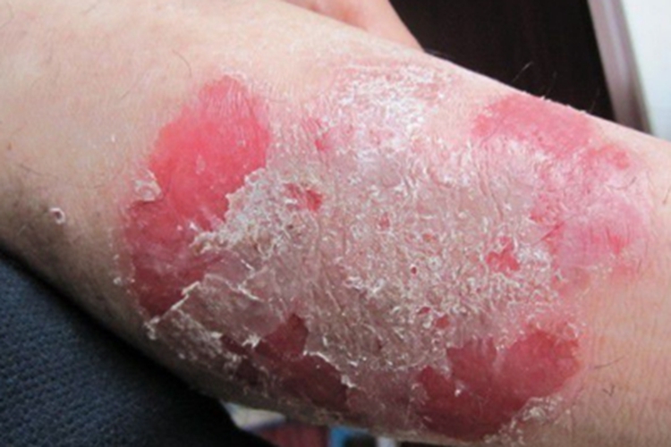 红皮病脱屑期胳膊症状图