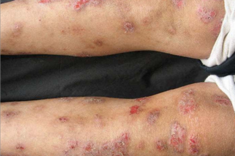 寻常狼疮小腿糜烂结痂图 寻常狼疮小腿糜烂结痂图