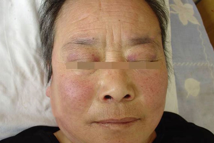 面部紫红色斑片图