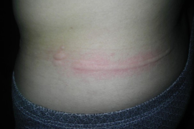 裤腰勒痕处皮损图