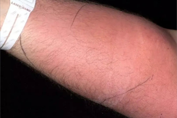 蜂窝织炎胳膊红肿图 蜂窝织炎胳膊红肿图