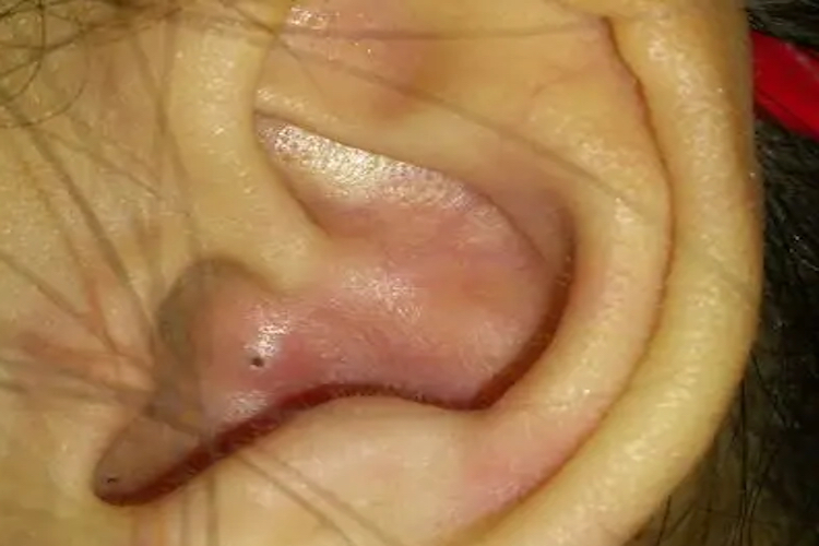 耳朵三角窝疖肿图