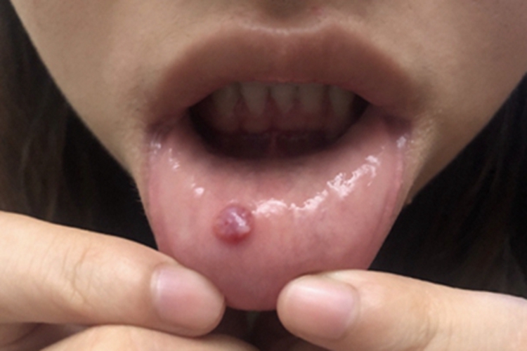 黏液腺囊肿大红疙瘩图 黏液腺囊肿大红疙瘩图