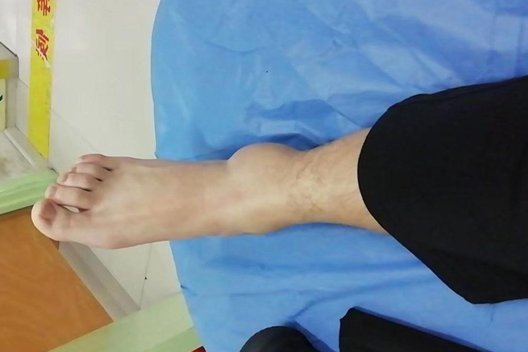 外踝骨折局部肿胀图