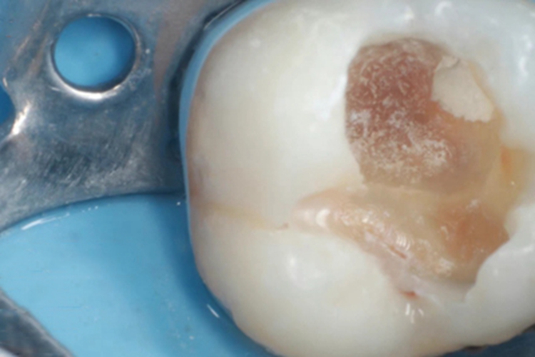 年轻恒牙龋牙齿渗液图