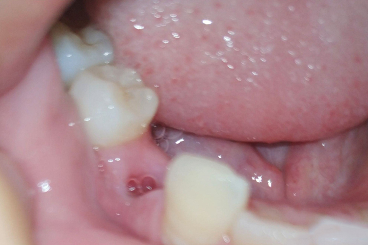 拔完牙30天后恢复图