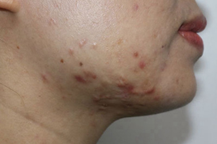 瘢痕疙瘩面部疙瘩图 瘢痕疙瘩面部疙瘩图