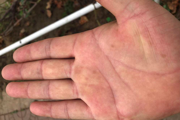 手掌心炎症后色素沉着图