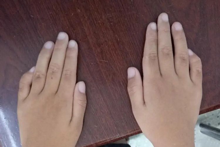 先天性手指外翻畸形图