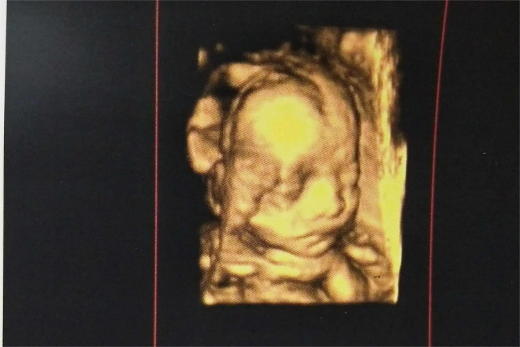 5个月胎儿彩超图 5个月胎儿彩超图