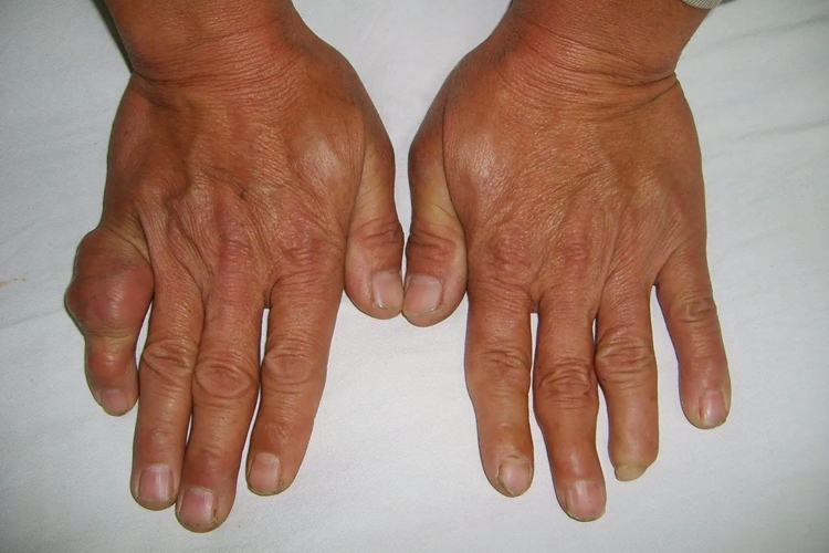 腱鞘巨细胞瘤图 腱鞘巨细胞瘤图