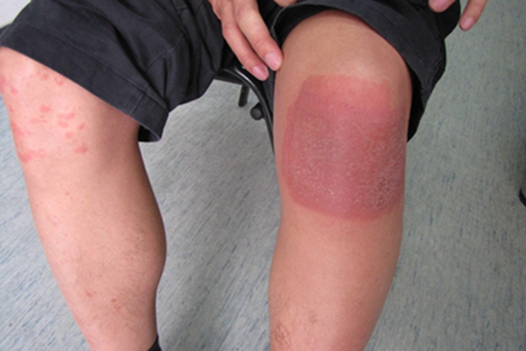 接触性皮炎膝盖症状图 接触性皮炎膝盖症状图