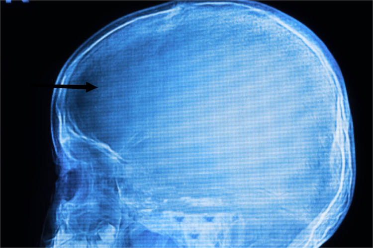 三岁孩子正常头骨图