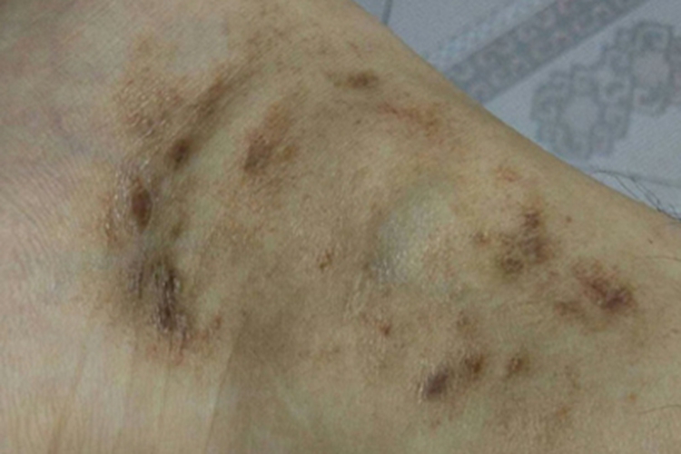 青斑性血管病脚踝症状图