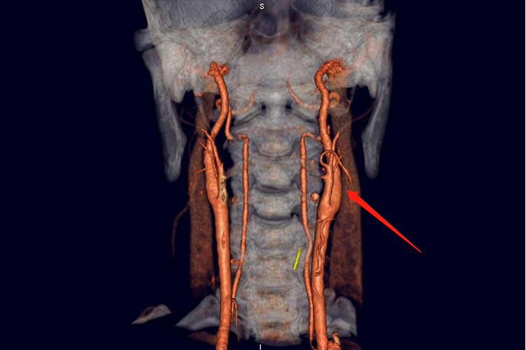 椎动脉型颈椎病CTA图