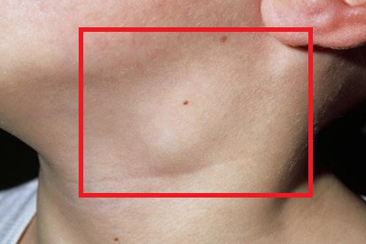 弓形虫病症状图 弓形虫病症状图