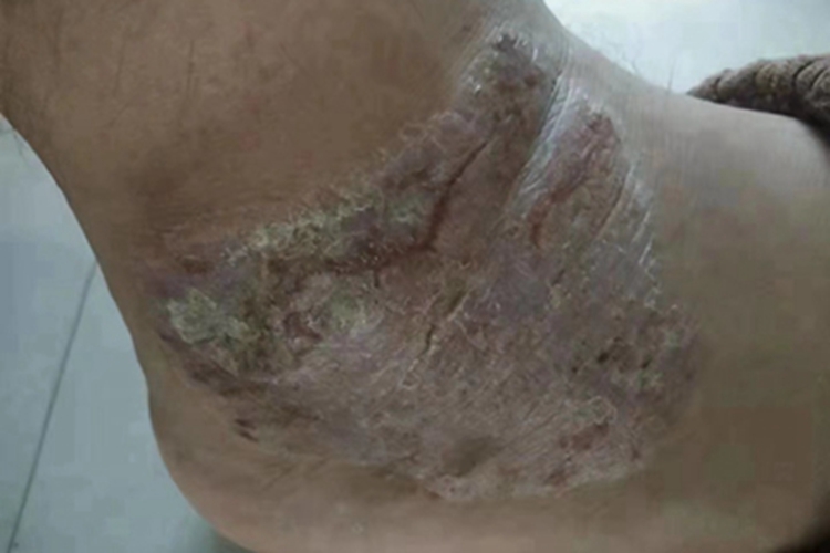 慢性湿疹脚踝皮肤增厚图