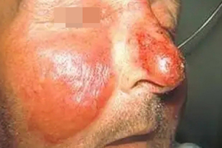 急性网状淋巴管炎面部红斑图