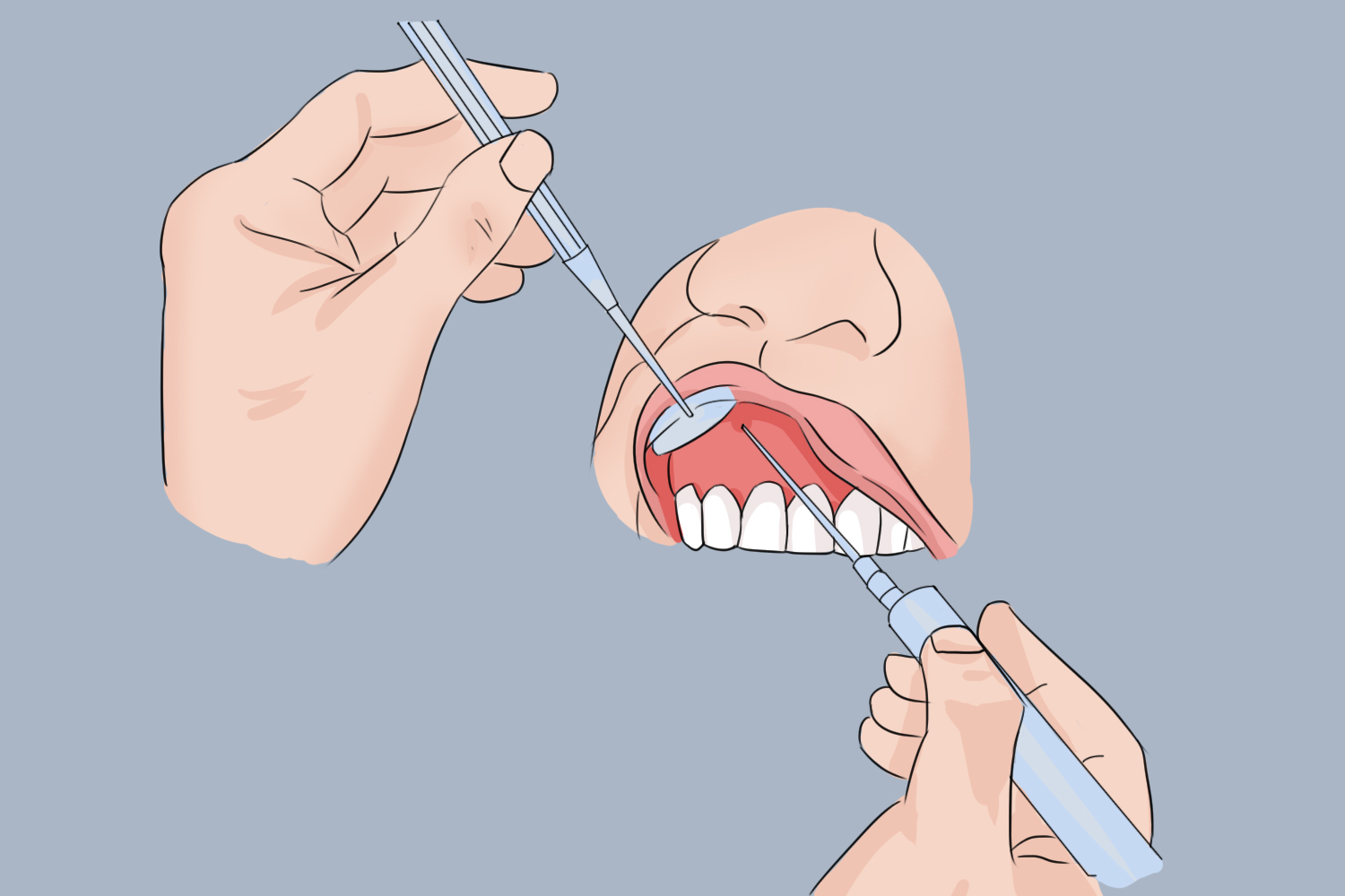 拔牙一周后可以补别的牙吗