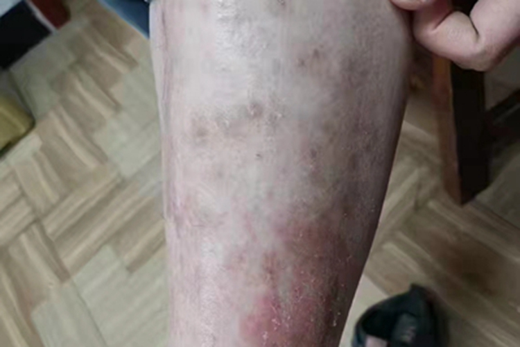 慢性湿疹小腿有色素沉着图