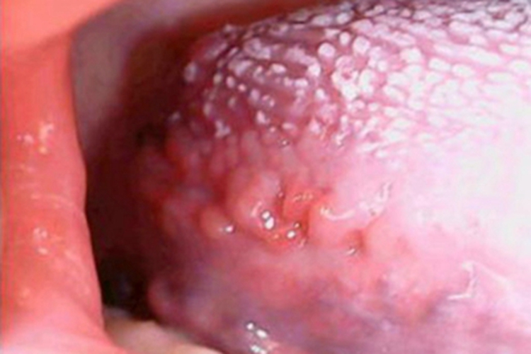 口腔尖锐湿疣舌侧疙瘩图