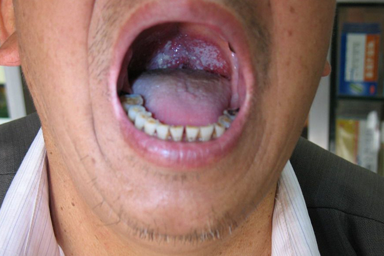 接触性口炎口腔黏膜烂图 接触性口炎口腔黏膜烂图