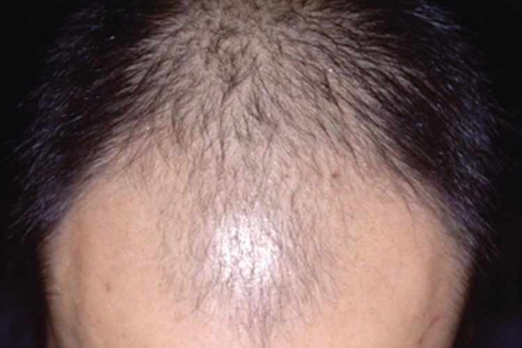 生长期脱发发际线后移图