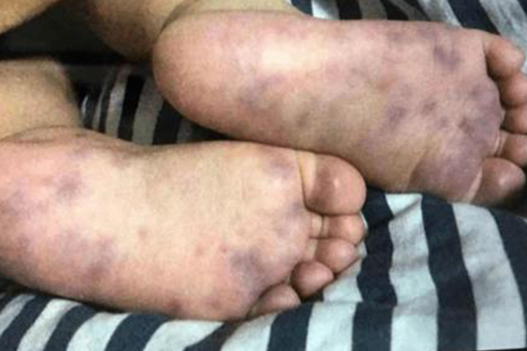 血小板减少症脚底出现紫色淤斑图 血小板减少症脚底出现紫色淤斑图