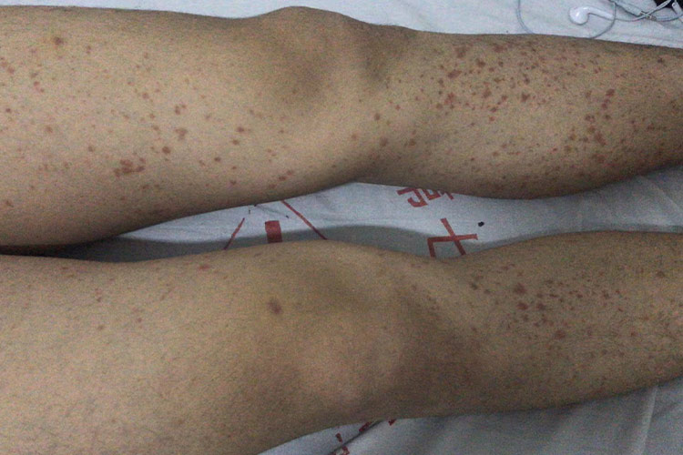 过敏性紫癜图 过敏性紫癜图