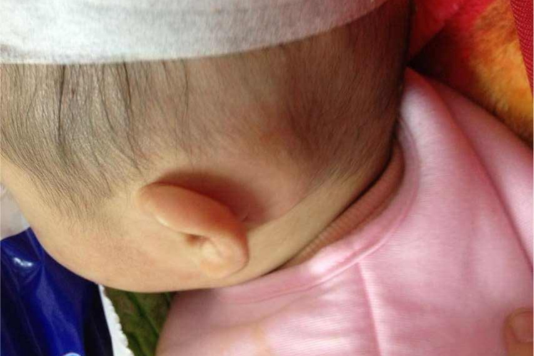 婴幼儿化脓性淋巴结炎耳后硬块图