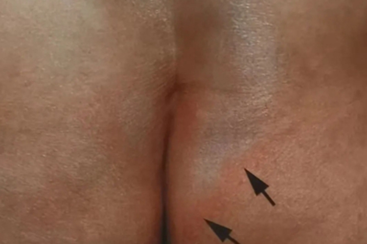 局限性硬皮病斑图