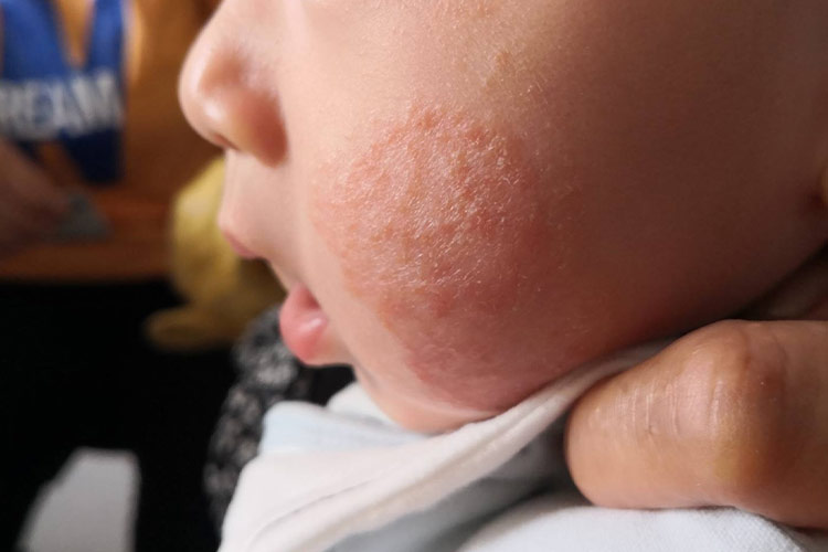 婴儿期特应性皮炎图