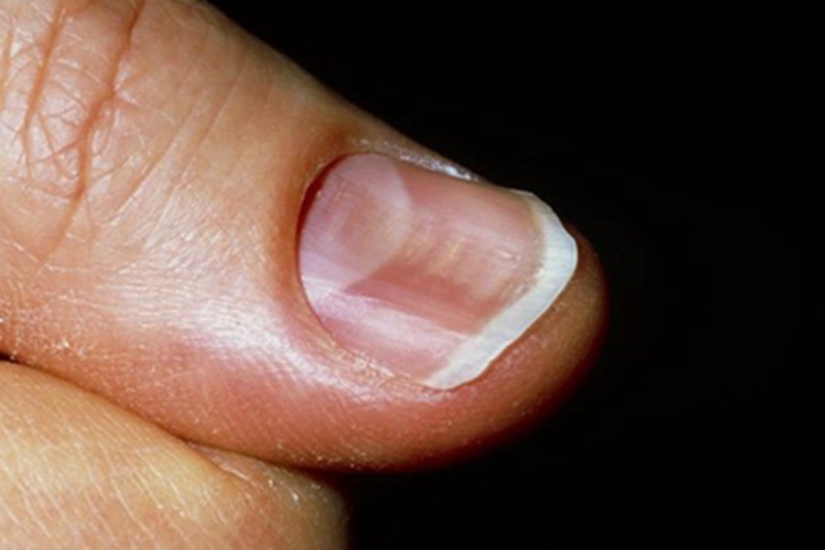 甲营养不良手指甲变形图