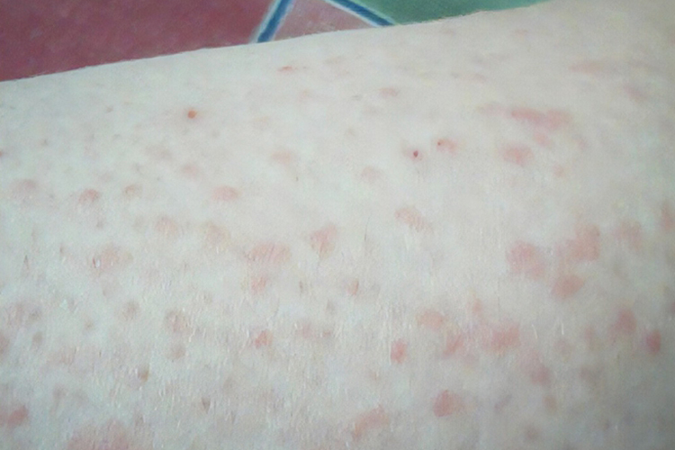 红色妊娠痒疹图