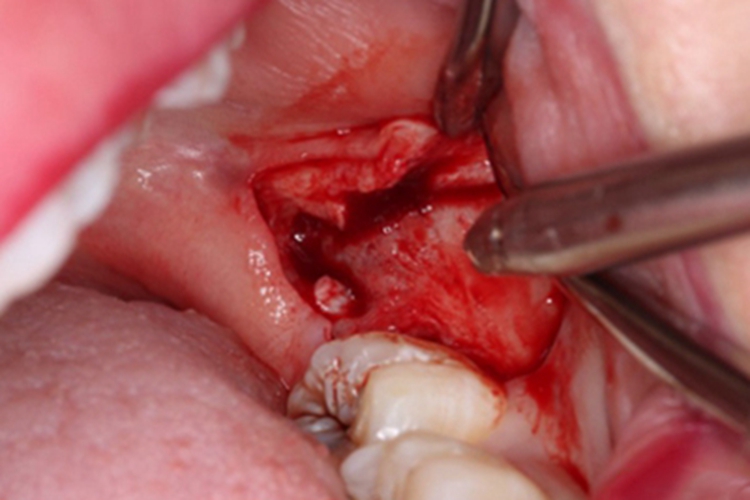 切开软组织及翻瓣图