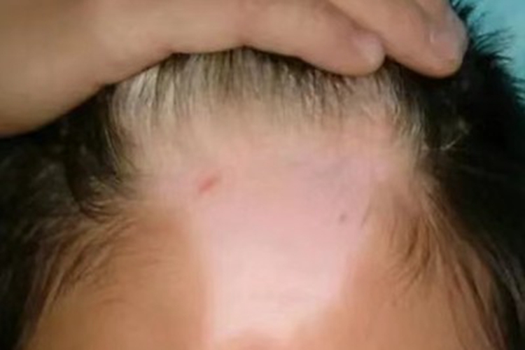 斑驳病额头白了一大块图