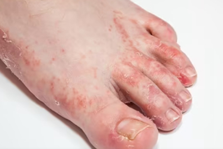 慢性黏膜皮肤念珠菌病脚部症状图