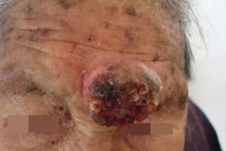 皮肤基底细胞癌前额大疙瘩图 皮肤基底细胞癌前额大疙瘩图